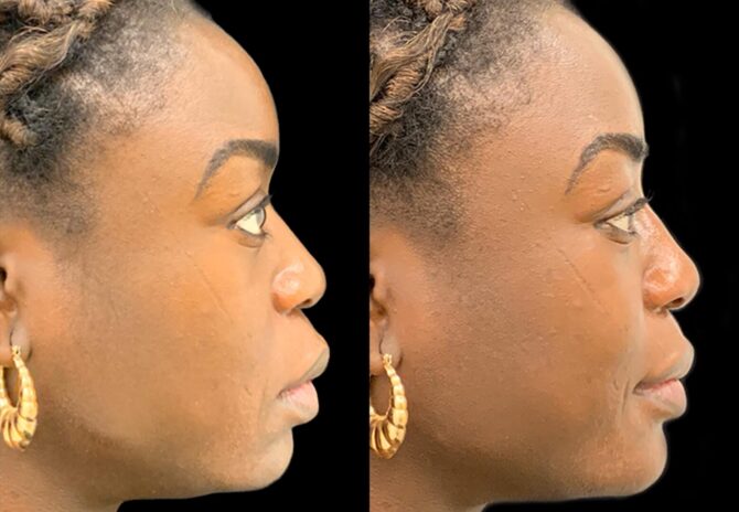 Dr Bob Khanna profiloplasty before and after