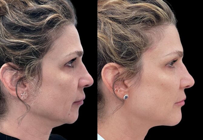 Dr Bob Khanna profiloplasty before and after