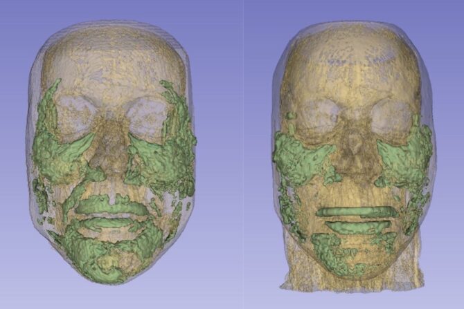 Alice's MRIs showing the amount of filler in 2025 (left) compared to 2021