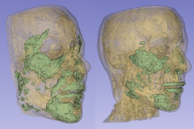 Alice's MRIs showing the amount of filler in 2025 (left) compared to 2021