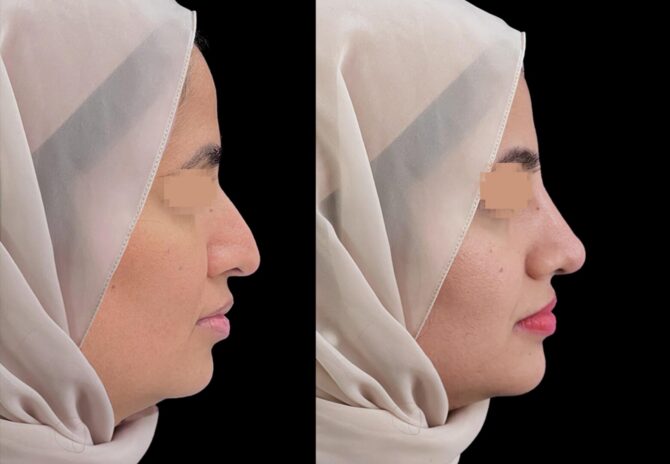 Dr Bob Khanna profiloplasty before and after