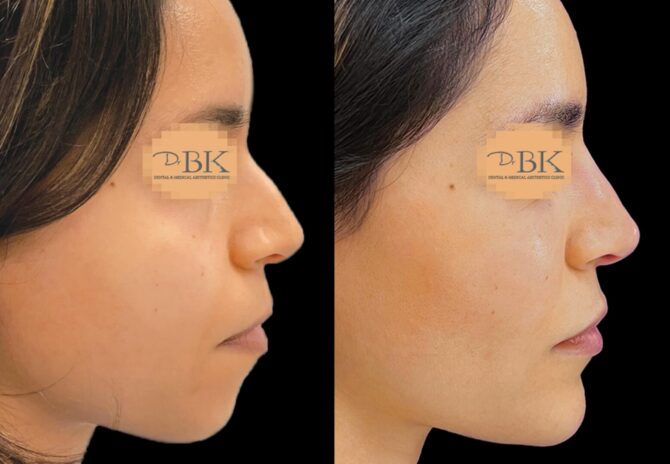 Dr Bob Khanna profiloplasty before and after