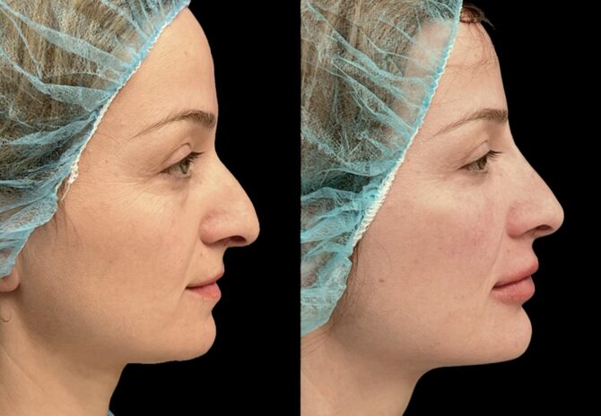Dr Bob Khanna profiloplasty before and after