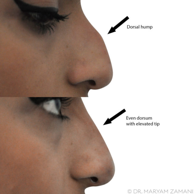 Non surgical rhinoplasty